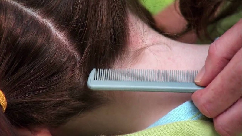 Cara Mengecek Kutu Rambut dan Telurnya: Langkah demi Langkah
